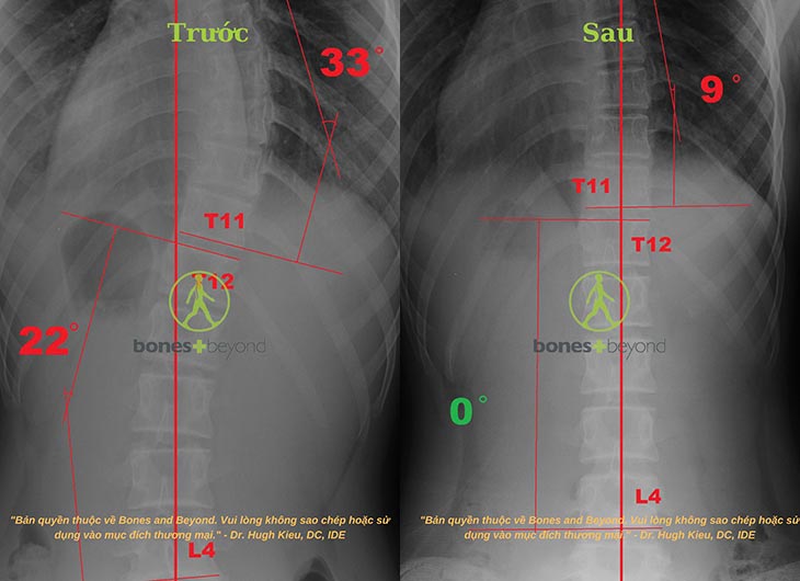 Cong vẹo mức độ trung bình (25-40 độ)