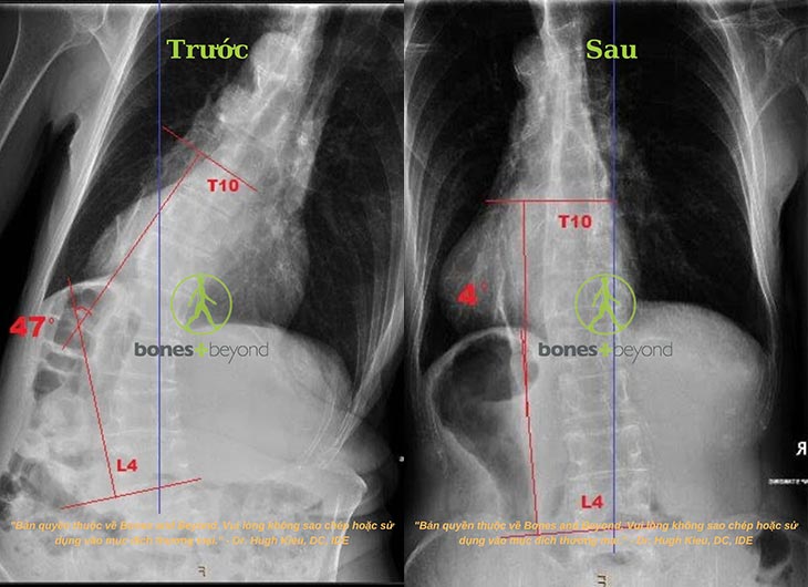 Cong vẹo mức độ nặng (từ 40 độ trở lên)